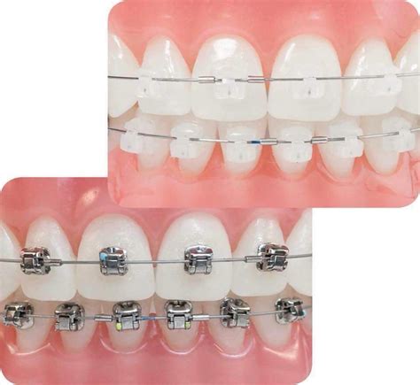 ava orthodontics|3m orthodontics.